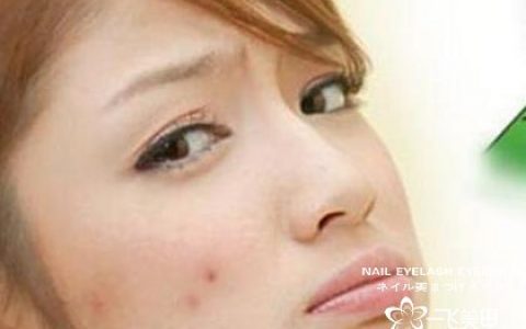 护肤小常识 将你如何快速祛痘