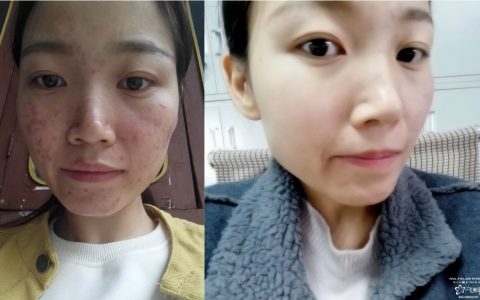 排毒去痘 5种食物快速排毒祛痘