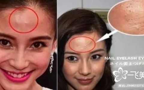 如何去除额头痘痘 这样做效果好