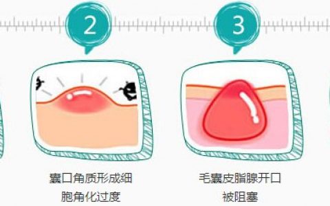 中医治疗痘痘 老中医教你如何去除痘痘