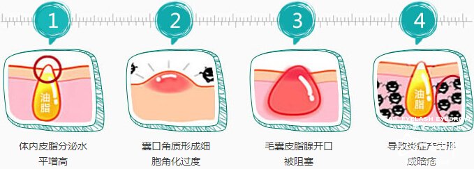 中医治疗痘痘 老中医教你如何去除痘痘