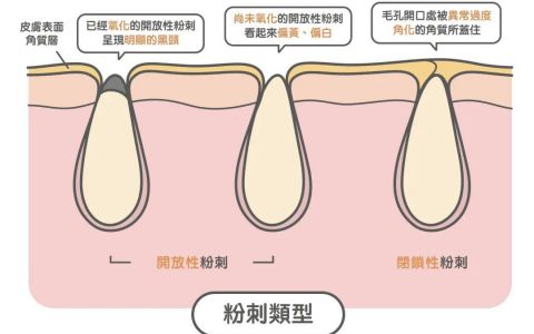 去黑头最全攻略！一篇告诉你黑头怎么去除最有效！