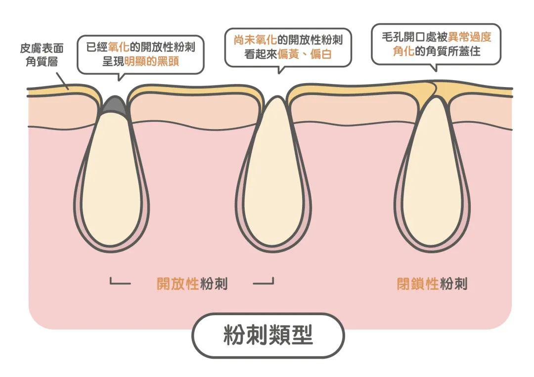 去黑头最全攻略！一篇告诉你黑头怎么去除最有效！