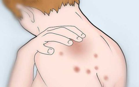 痘痘为什么一直反反复复的，来看原因吧