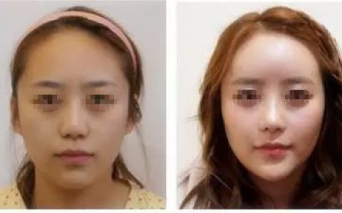 自体脂肪填充，你不知道的都在这里！