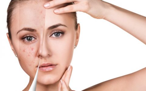 痘痘肌肤怎么改善，这几点千万要注意
