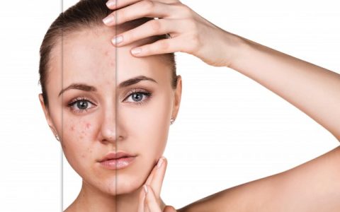 脸上起痘怎么调理，脸上容易长痘痘调理技巧