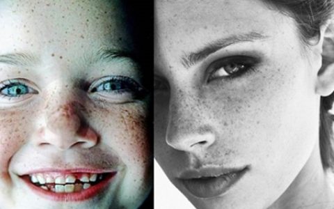 【图】激光祛斑的原理是什么，有哪些好处