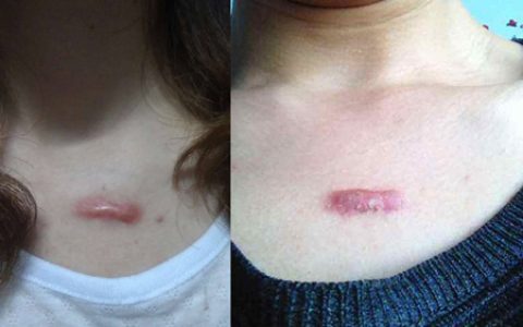 【图】激光祛疤后悔死了，它的原理你知道哪些