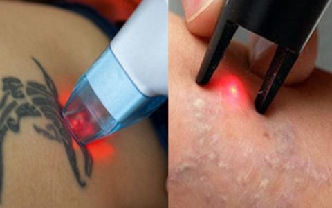 【图】纹身去除法会有伤疤吗，，美肤需谨慎