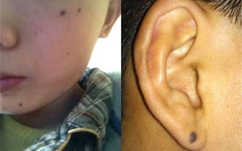 【图】激光点痣的效果怎么样，这些注意事项你要知道