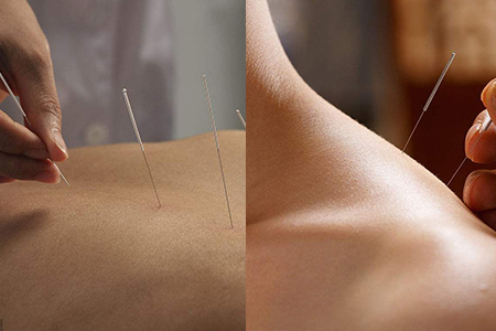 针灸减肥反弹厉害吗，瘦身秘诀你要知道