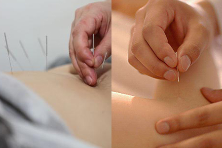 针灸减肥反弹厉害吗，瘦身秘诀你要知道