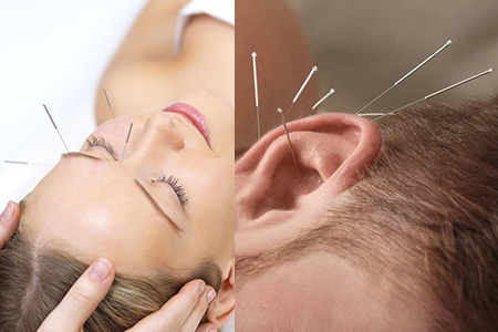 针灸减肥反弹厉害吗，瘦身秘诀你要知道