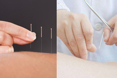 针灸减肥反弹厉害吗，瘦身秘诀你要知道