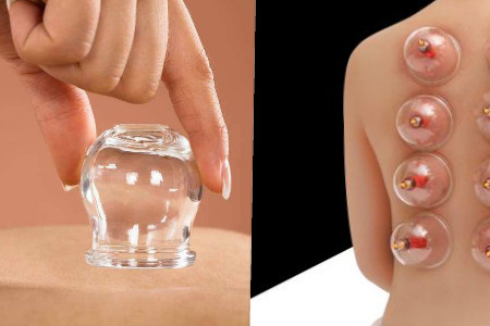 拔火罐减肥的原理详解，这些注意事项需牢记