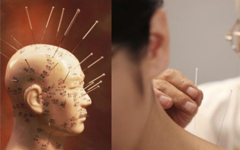 针灸减肥位置图，，有哪些正确的步骤