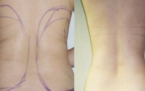 【图】如何减肥吸脂，教你全身减肥小妙招