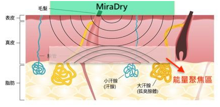 miraDry清新微波：腋臭基因到底有多强大，看看这些内容就知道