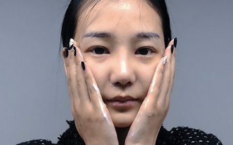 脸部皱纹怎么办