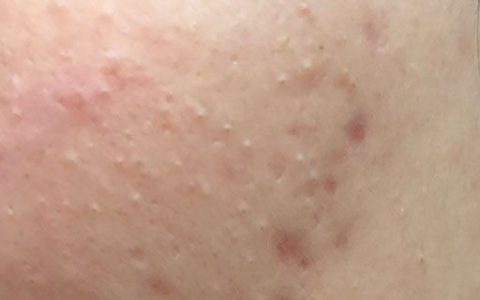 点斑掉痂后能擦粉底吗