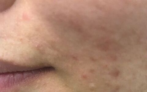 怎样可以快速去粉刺