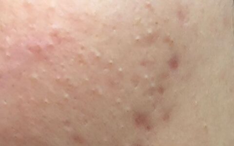 怎样简单的消除痘痘