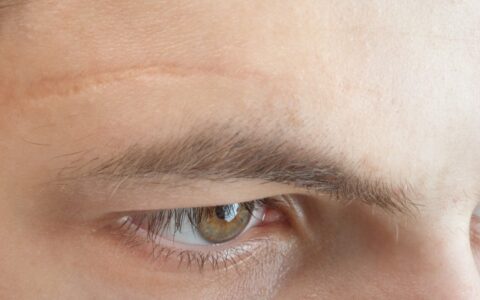 疤痕总是难以消失，珍藏淡疤小窍门送给你