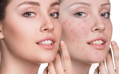 闭合性粉刺怎么排出来，这4点需要注意