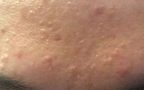 涂水乳要避开痘痘嘛