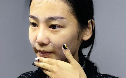 日晒斑怎样去除