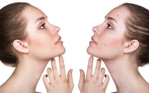 脸上痘痘痤疮怎么调理，这样做能有效缓解