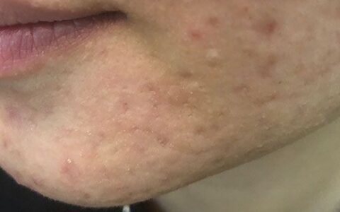 挑痘痘之后要怎么护理