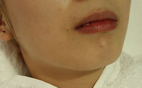 漂唇后多久可以涂口红