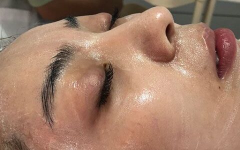 脸上皱纹多了怎么能除掉