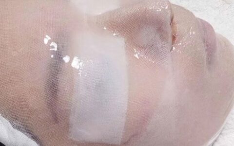 点完痣可以敷面膜吗