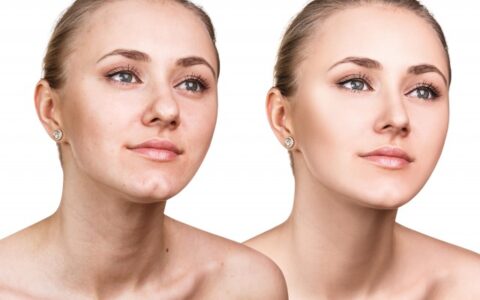 如何去闭口粉刺，教你正确去闭口的方法