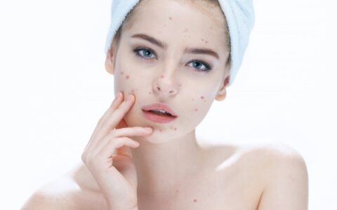 快速祛痘印的方法，4种方法总有一种适合你