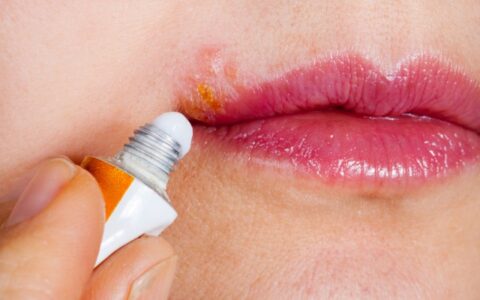 嘴边长痘痘怎么消除的妙招，4个方法有效去痘痘
