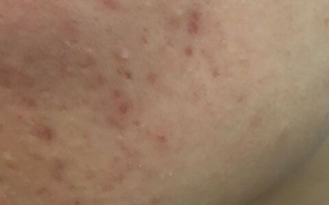 脸上黑印怎么快速消除