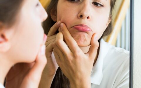 闭合性痘痘怎么办，如何应对闭合性痘痘这个讨厌的肌肤问题