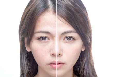 怎么清除痘痘，有效调理痘痘肌的方法