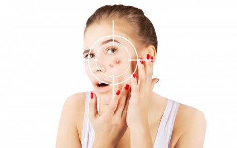 怎样快速去红色痘印，如何预防痘印产生