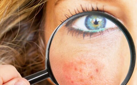 脸部皮肤角质层薄怎么护理，角质层薄的敏感肌护理方法