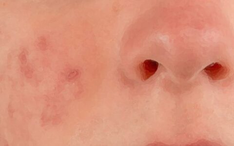 柠檬汁可以祛痘吗 这样做最快最有效