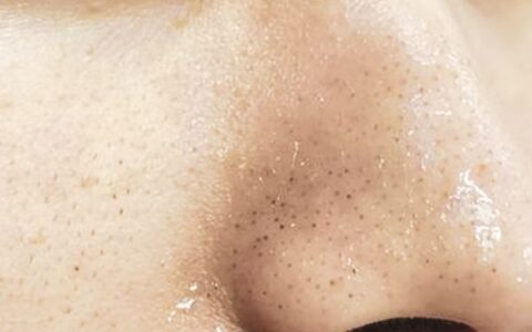 脸上顽固黑头怎么去除 简单秘方还你光滑美肌