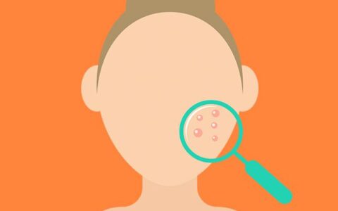 熬夜长痘痘如何消除 正确护肤方法还你嫩白无瑕肌