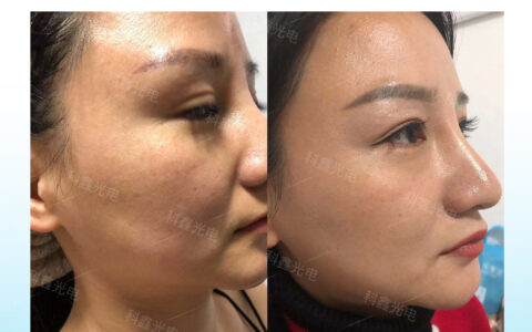 做完点阵激光术后怎么修复和护理？