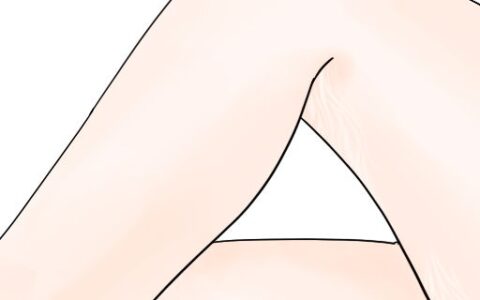 大腿生长纹怎么去除
