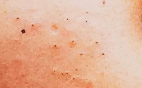 闭口粉刺不美观，怎么才能避免